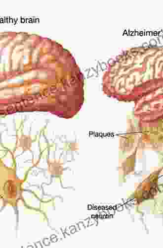 The Alzheimer S Answer: Reduce Your Risk And Keep Your Brain Healthy